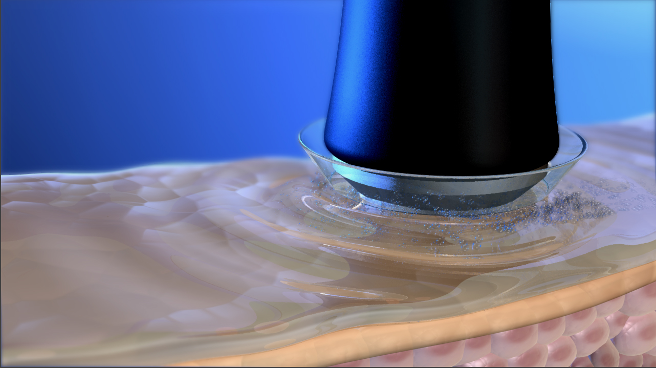 Ultrasound waves